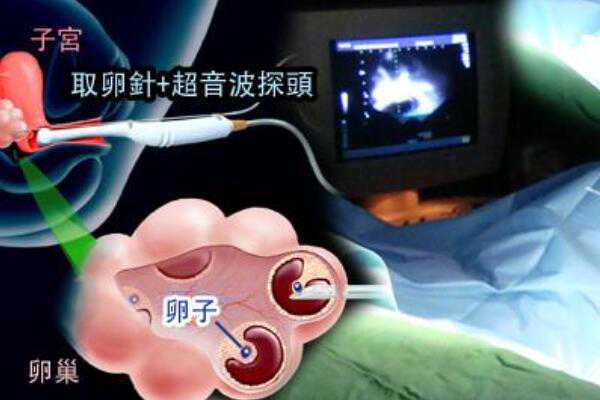 杭州代孕费用包成功,杭州试管婴儿价格多少？